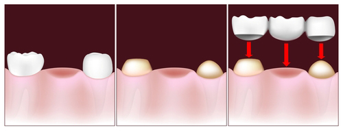 dental-crowns-and-bridges-to-replace-missing-tooth